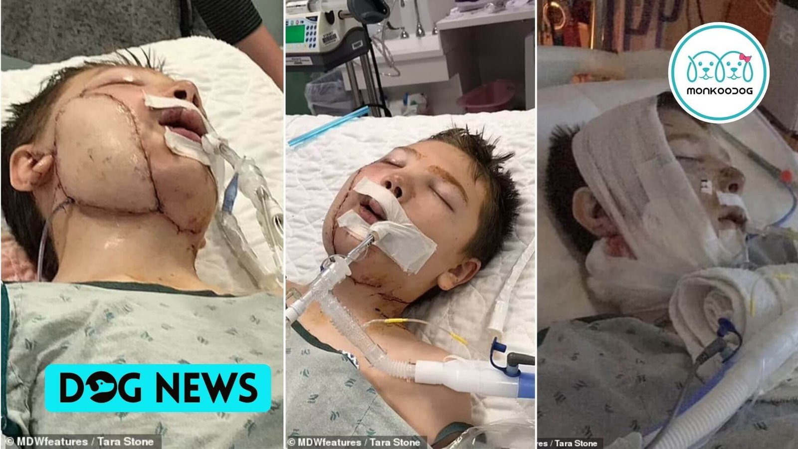 A 13-year-old boy got attacked by a neighbor’s pitbull, leaving the jaw, throat, arteries, and voice box exposed with face muscles hanging